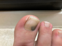 閲覧注意です 足の爪がここだけ変色しているのですが治す方法は Yahoo 知恵袋