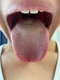 奥の奥の方まで舌苔がつく原因はなんですかみんなと同じもの食べてもこん Yahoo 知恵袋