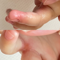 1歳の子供の指の水泡 荒れについて質問です 子供の手の指1本だ Yahoo 知恵袋