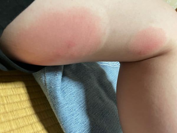 この刺され方は蚊ですか ブヨですか 画像気持ち悪くてすみません Yahoo 知恵袋