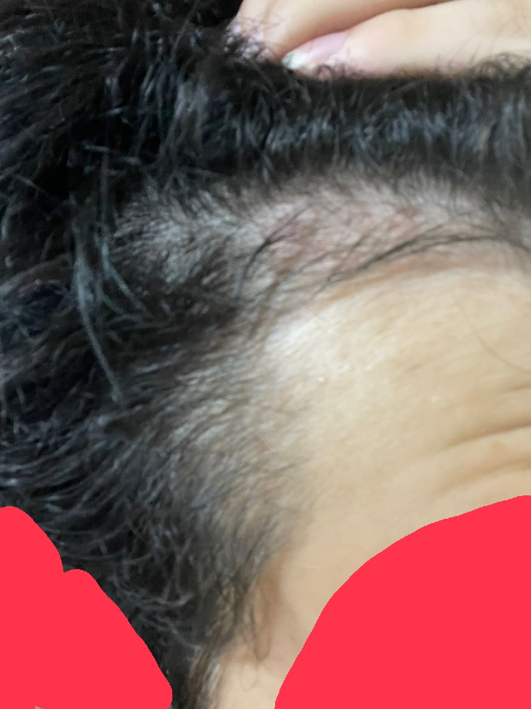 高校一年生15歳男性です これって禿げてきてますかね 比較的に髪質は硬く太い Yahoo 知恵袋