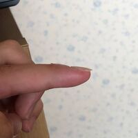 マレット骨折のピンニング手術後 腫れが引かず曲げようとしても皮膚が引っ張られる Yahoo 知恵袋