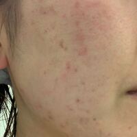 美容皮膚科でケミカルピーリングを6回ほどやっていますがあまり効果を感じられない Yahoo 知恵袋