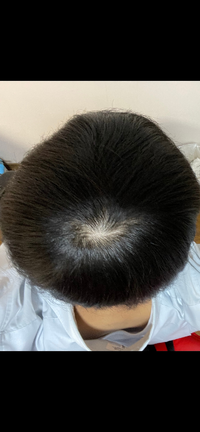 高校2年生ですこれはつむじハゲぽいですか お願いします Yahoo 知恵袋