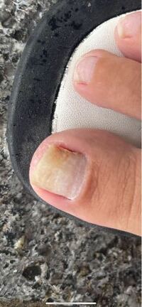 フットネイルをオフしたらネイリストさんに 爪が弱ってます。
剥離していてポロポロしてると言われました。

親指の爪だけこんな感じになってます
これの原因わかる方いますか？