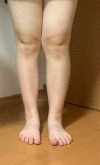 閲覧注意 膝裏が汚いのはごめんなさい この脚で脚がでるような膝くらい Yahoo 知恵袋