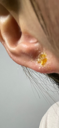 ピアスホールの周りの裏表の白いカピカピはどうしたらいいですか 2月 Yahoo 知恵袋