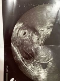 最終月経からのカウントだと6週3日で産婦人科受診した際のエコー写真で Yahoo 知恵袋