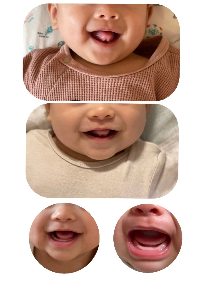 生後5ヶ月の赤ちゃんの舌 裏側がハート 舌小帯短縮症でしょうか ハート舌 Yahoo 知恵袋