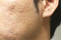 彼氏がこの肌に限りなく近いです このような凸凹の肌になる原因って何なので Yahoo 知恵袋