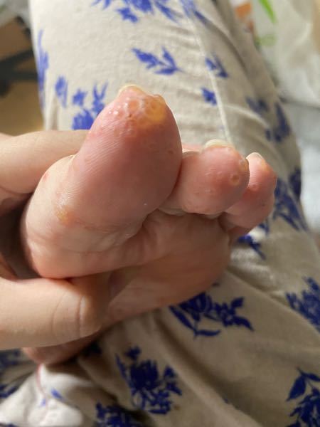 水虫 投票受付中の質問 Yahoo 知恵袋