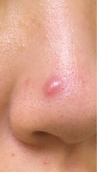 鼻にどでかいニキビができてしまいました ふだんニキビができた時 Yahoo 知恵袋