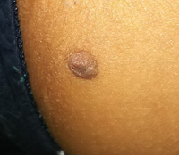 イボ ホクロ 股の近くに元々あったのですが去年まぶたに皮膚扁平上皮がんが出来て Yahoo 知恵袋