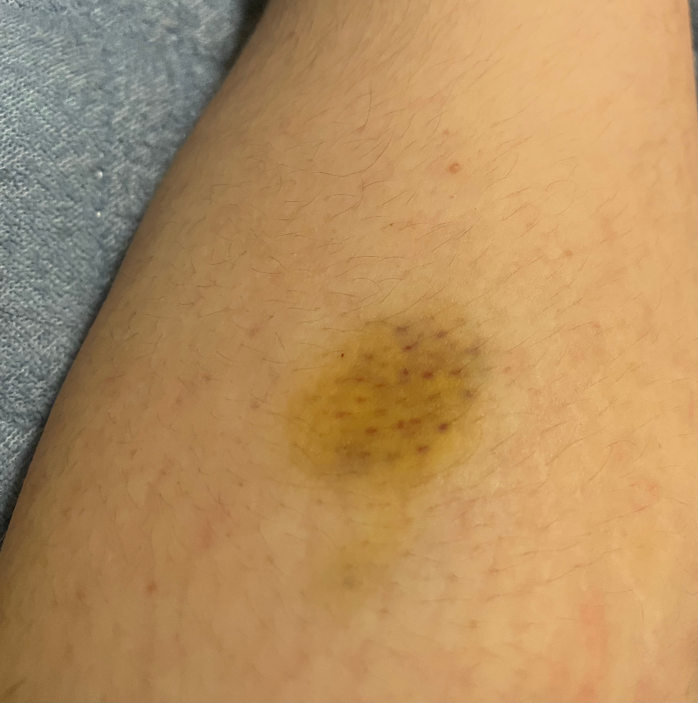 私の胸にある黄色い斑点は何ですか?
