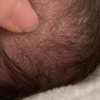 生後2ヶ月半の赤ちゃんの頭皮にこんなカサカサができているのを急に発見したのです Yahoo 知恵袋