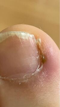 足の爪の横が黒いのが気になります 親指なんですが 立つのも辛いのが2日程 Yahoo 知恵袋