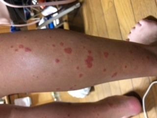 子供の湿疹について 至急お願いします 先々週 小3の子が学校から帰っ Yahoo 知恵袋