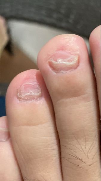 水虫 すべての質問 Yahoo 知恵袋
