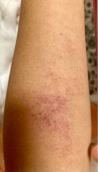 子供 4歳 に薬疹らしきものができてしまいました 薬疹が出るのは ２回目 Yahoo 知恵袋