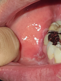 口内 歯茎にできている白い線みたいなのはなんでしょうか 特に痛みはないのですが Yahoo 知恵袋