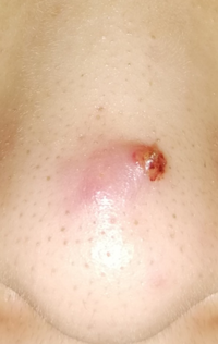 鼻ニキビのかさぶたが取れ 写真のような状態なのですがどうしたら治りま Yahoo 知恵袋