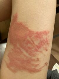 早急お願いします 火傷をしてリンデロンvgを塗ってましたが ここから一向 Yahoo 知恵袋