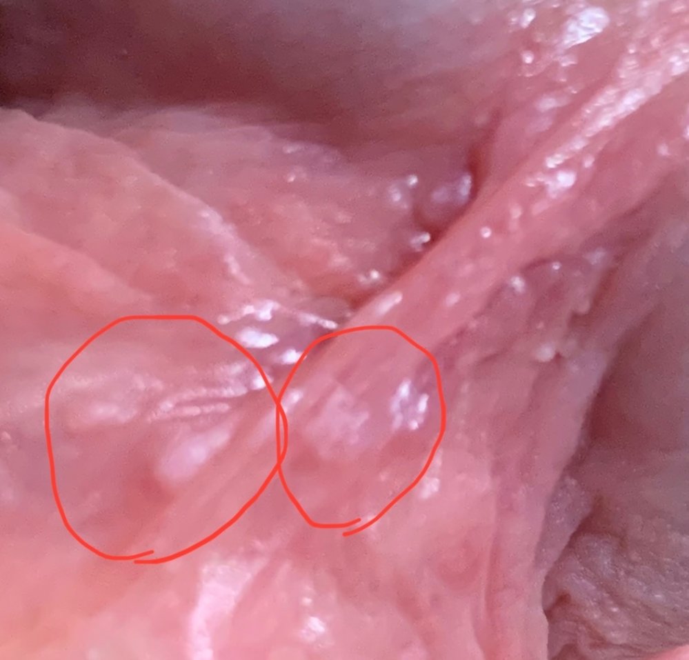 尖圭コンジローマでしょうか 数週間前に裏筋の根本に 白いできもの Yahoo 知恵袋