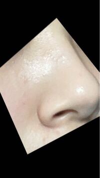 肌荒れについて 白ニキビ ですかね 鼻を中心としてすごくプツプツしてい Yahoo 知恵袋