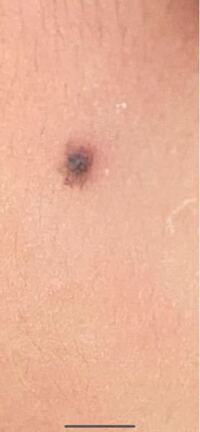 子供のほくろなんですが これは 普通でしょうか どんどん大きくな Yahoo 知恵袋