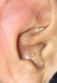 最近耳の中に白いできものが出来てしまったのですが これはなんです Yahoo 知恵袋