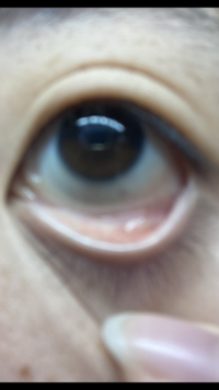 観覧注意です左目の写真なんですが左目の下まぶたをめくると白く腫れてい Yahoo 知恵袋