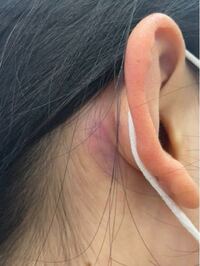 昨日耳の裏を壁の角で思いっきりぶつけてしまいました 今朝見てみると腫 Yahoo 知恵袋