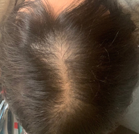 妊娠6ヶ月目髪が信じられないぐらい薄いです 25歳 いつもはパウダー Yahoo 知恵袋