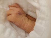 生後3日の赤ちゃんです 手の甲にふと見たら写真のようなアザ がついてまし Yahoo 知恵袋