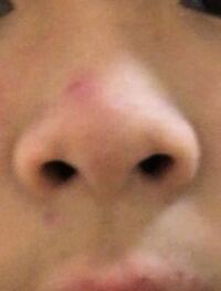 画像付きです この鼻って団子鼻ですか？ 