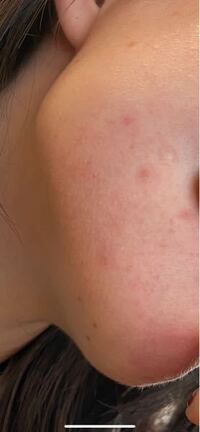 フェイスラインにたくさんできる 白いブツブツの正体 皮膚 Yahoo 知恵袋