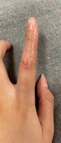 ゆず風呂で柚を揉んで遊んでいたのですが お風呂上がりにふと見たら左の人差し指だけ この様なことになってしまってました。 他の指はなんともありません 痛みも痒みも今のところないです