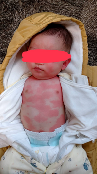 9ヶ月の子供にミルクをあげると 眉毛のあたりが赤くなります 毎回な Yahoo 知恵袋