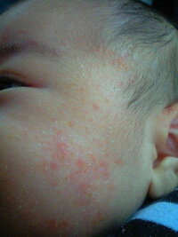 乳児湿疹 これは乳児湿疹でいいのでしょうか 水曜日に小児科を受診し ステロイド Yahoo 知恵袋
