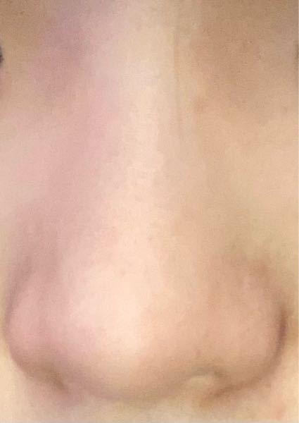 この鼻をIVEのウォニョンちゃんみたいな鼻に整形するには大体何円かかりますか？