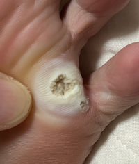 これは魚の目でしょうか イボコロリを2週間ほど続け芯のような黒い塊が Yahoo 知恵袋