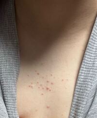 前々から腕や背中 たまに谷間の部分 のニキビ のような出来物が気になってて皮 Yahoo 知恵袋