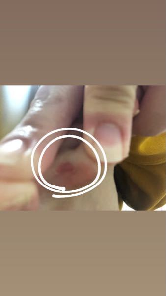 写真がボケてしまって わかりにくいですが 足の薬指の皮が剥がれて痛いです。 小指と隣接してるところです。 水虫でしょうか？