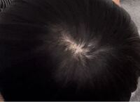 17歳男性です まだ学生で 毎日髪もしっかり洗っています なのに つむじ Yahoo 知恵袋