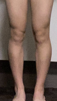 O脚ですか 膝から下が外側に曲がっているんですが これはo脚ですか Yahoo 知恵袋