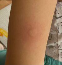 画像あり 子供の腕に蕁麻疹 8歳の子供の腕にポツンと出来て熱を持ってい Yahoo 知恵袋
