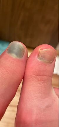 昨日バレエのレッスンをしている時 足が痛くてトゥシューズを脱ぎ見てみたら 足の Yahoo 知恵袋