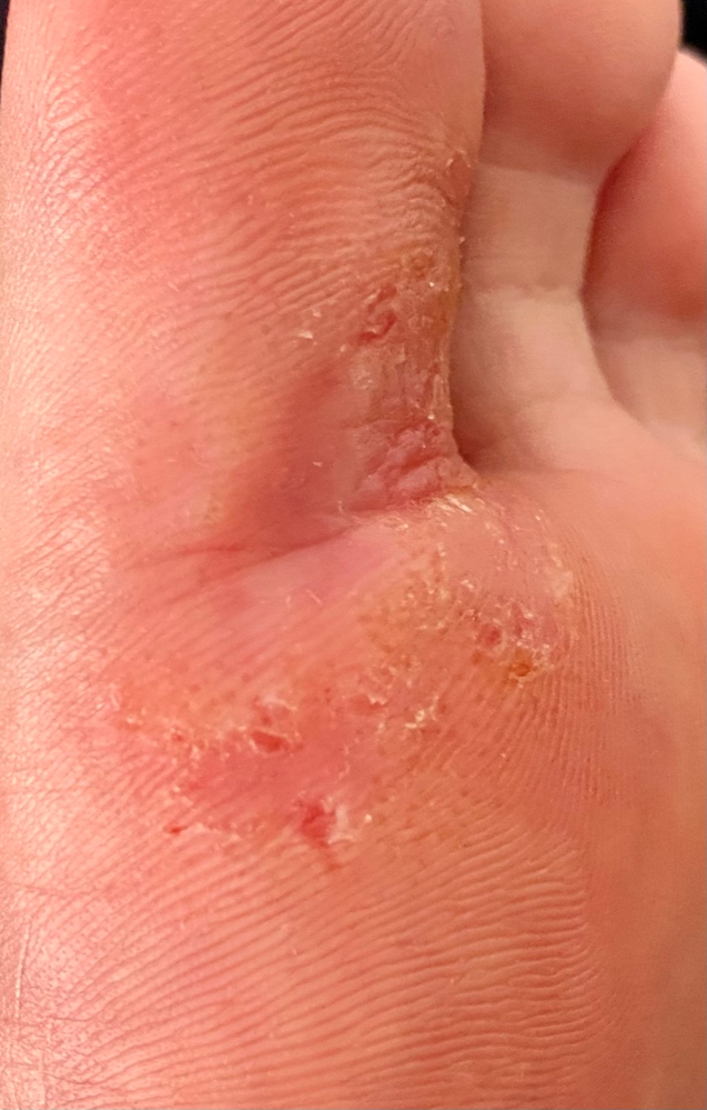 【※閲覧注意】 汚い画像が出てきます。 閲覧注意です。 1年前くらいから足の親指に小さな水疱がたくさんでき始め、水虫かと思い病院に行きました。 水虫かなぁ？とのことで薬を処方してもらい抗真菌...