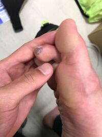 人工芝で久しぶりにサッカーをしたら足の裏に血豆のようなものが Yahoo 知恵袋