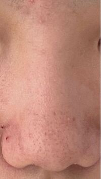 高校生女子です ひどい団子鼻で悩んでいます どのようなシェーディ Yahoo 知恵袋